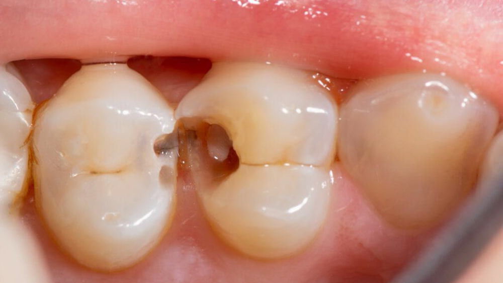 تصویر سه دندان که دندان وسط و دندان چپ دارای پوسیدگی بین دندانی هستند