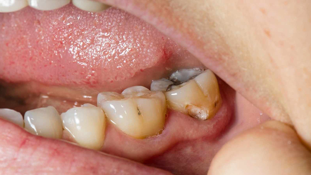 دندان آسیاب با پوسیدگی بین لثه و دندان