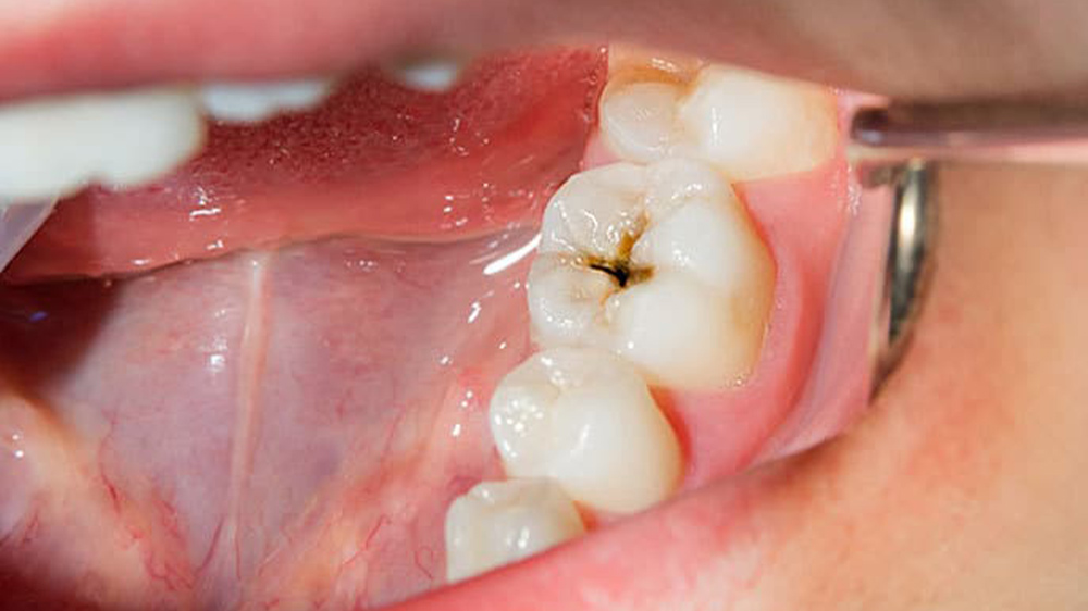 tooth decay on fissures of the chewing surfaces