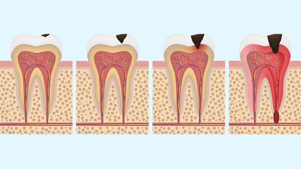 Tooth decay stages
