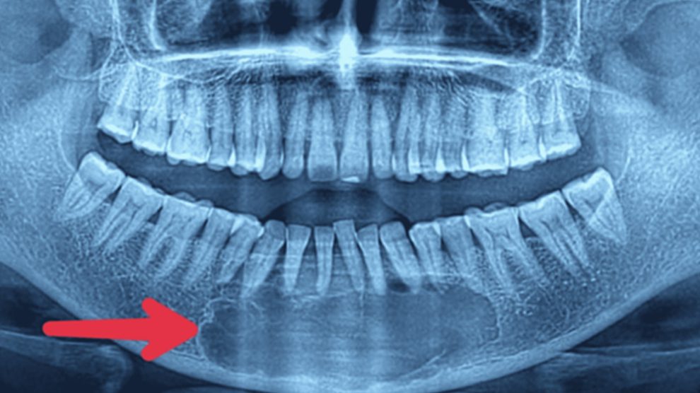 Jaw Tumors Dr Jamilian 5049