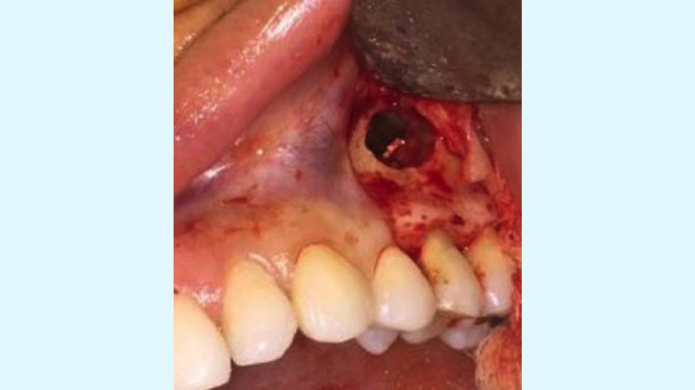 نمایی نزدیک از حفره ایجاد شده برای جراحی لیفت سینوس