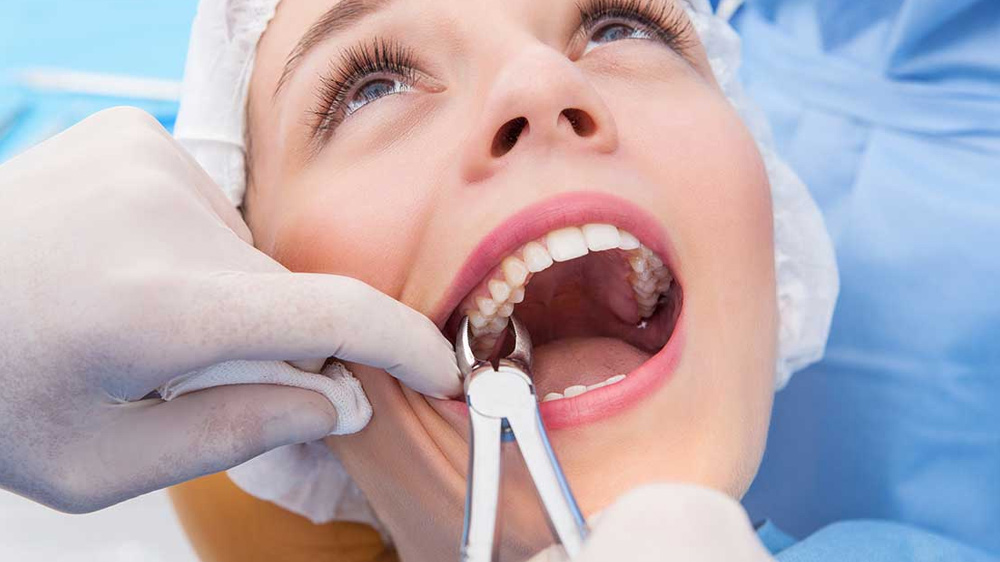 نمایی از دهان یک بیمار خانم که دندانپزشک در حال کشیدن دندان مولر فک بالای او‌ می باشد.