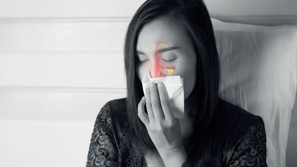 Sinus Opening Due To Tooth Extraction Dr Jamilian