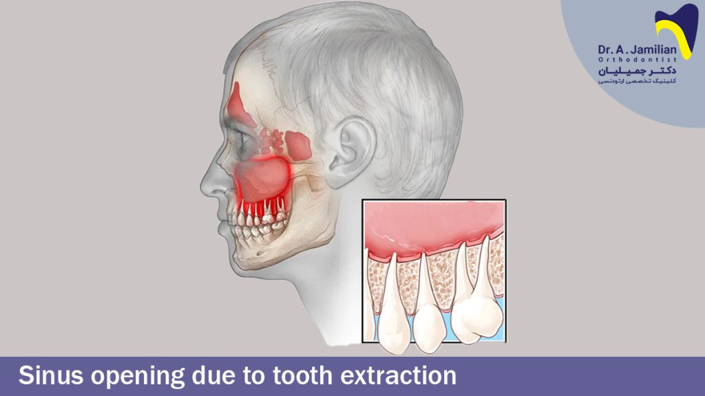 Sinus Opening Due To Tooth Extraction - Dr Jamilian