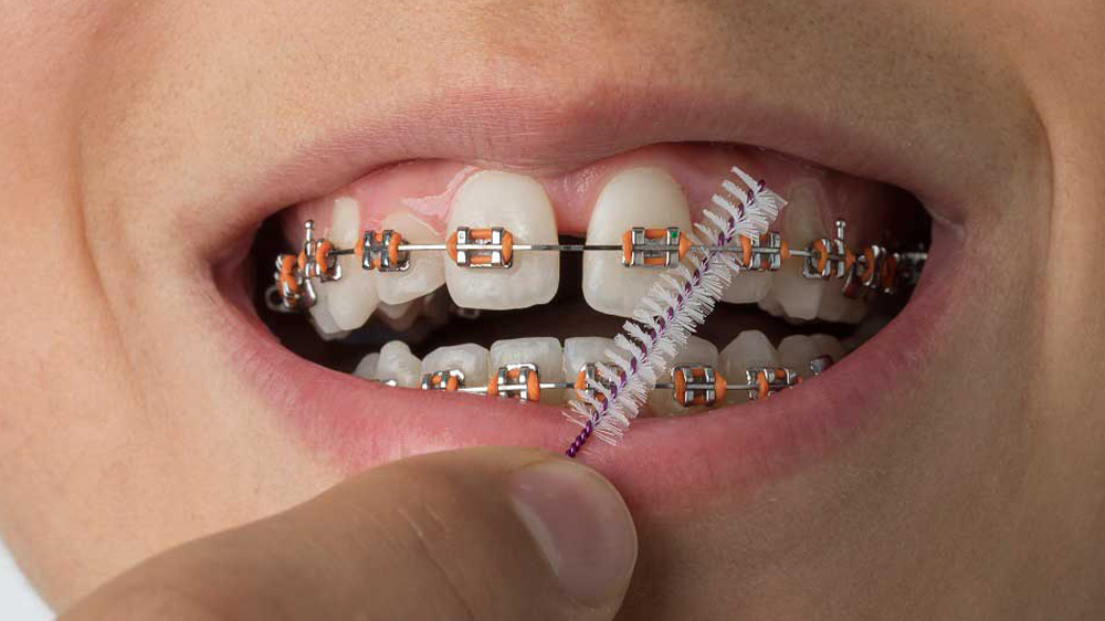 استفاده از مسواک بین دندانی برای تمیز کردن فاصله ی بین دندان ها و براکت های ارتودنسی