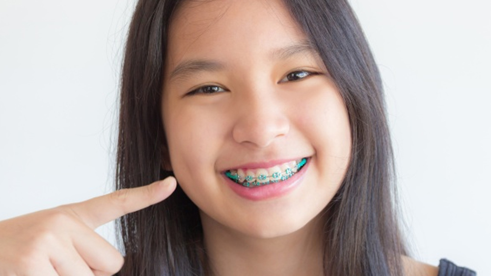 دختری خوشحال و درحال اشاره به دندان های ارتودنسی شده خود