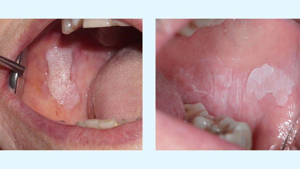 نمای نزدیک از توده های سرطانی داخل دهان بیمار