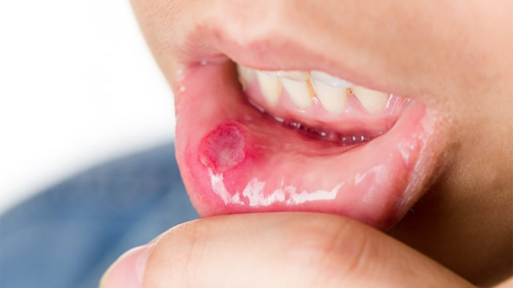an example of wound behind the lower lip suspected to be cancerous mass