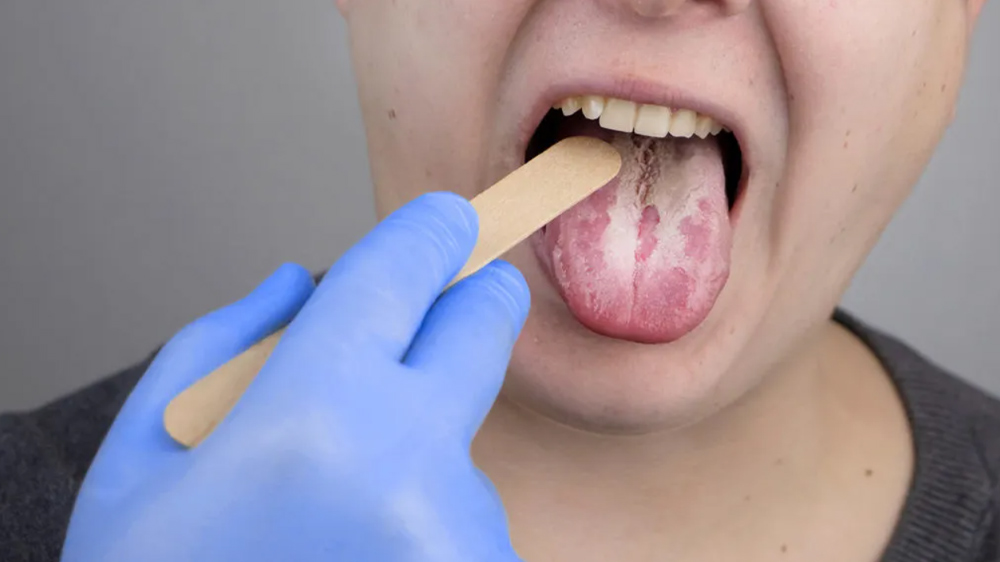 دندانپزشک در حال معاینه برفک دهان یا کاندیدیازیس دهان