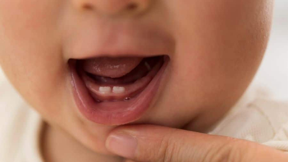کودکی که با دندان نوزادی متولد شده است.