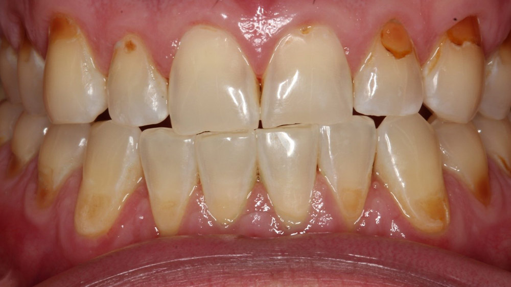 teeth enamels with cavities in them