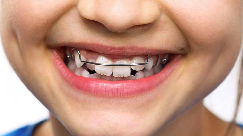 smiling kid having removable orthodontics on