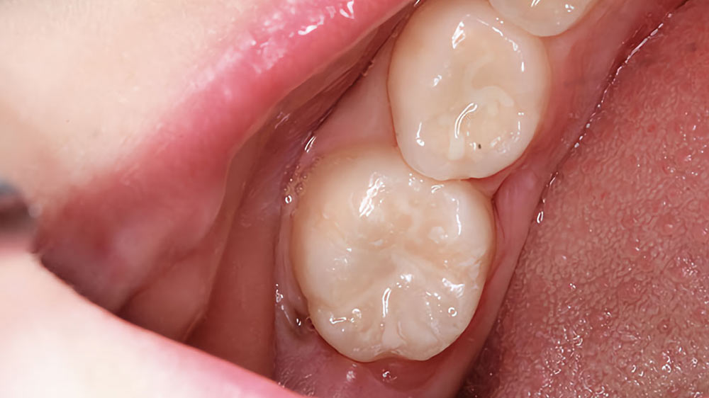 تصویری از فیشور سیلانت دندان های شماره 6 و 7 فک پایین