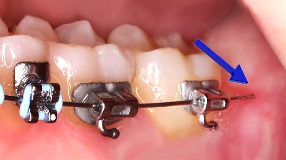 long poking wire in orthodontics shown with a blue arrow