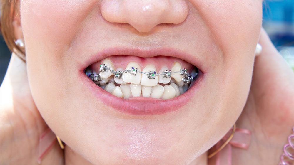 woman with orthodontic bracket on crooked teeth