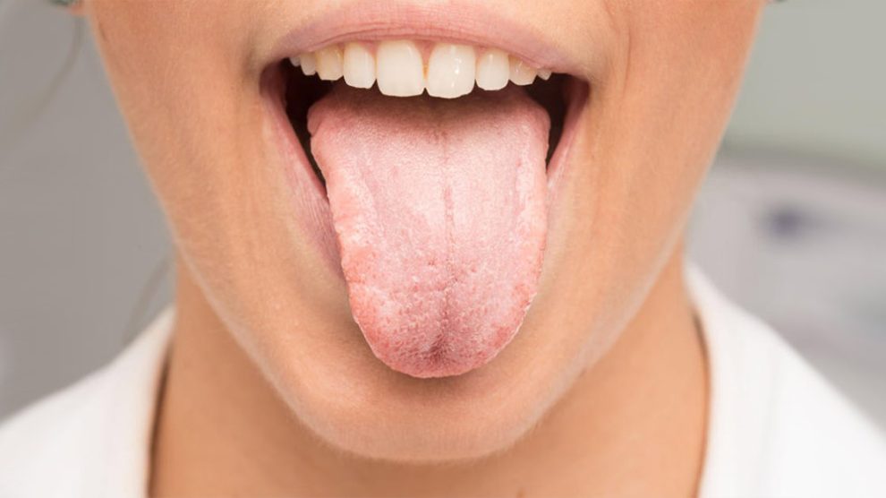 Weiße Flecken im Mundraum oder Leukoplakie - Dr Jamilian