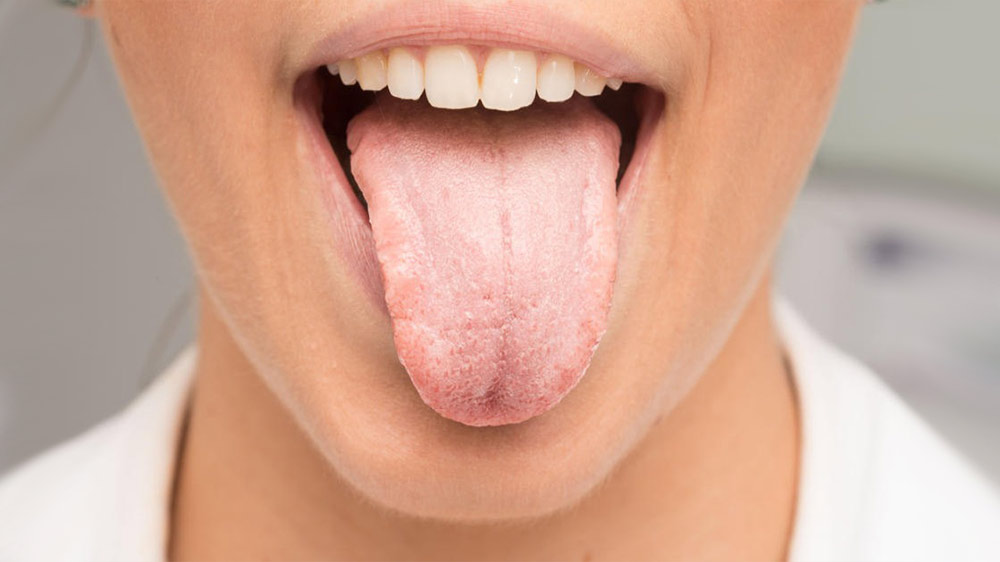 leukoplakia on tongue