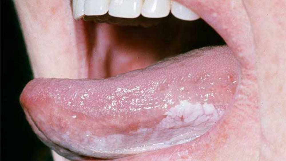 White spots under the tongue