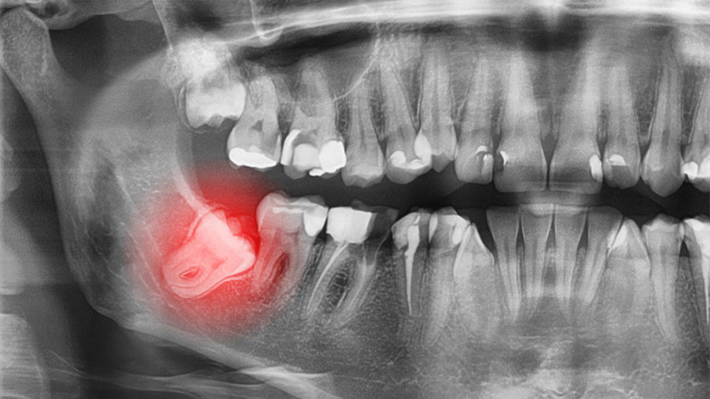 دندان عقل نهفته بر روی عصب فک قرار گرفته است.