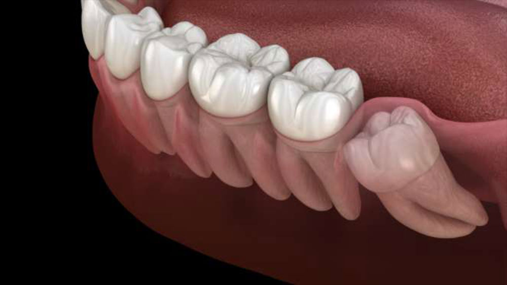 دندان عقل نهفته میانی و چند دندان دیگر