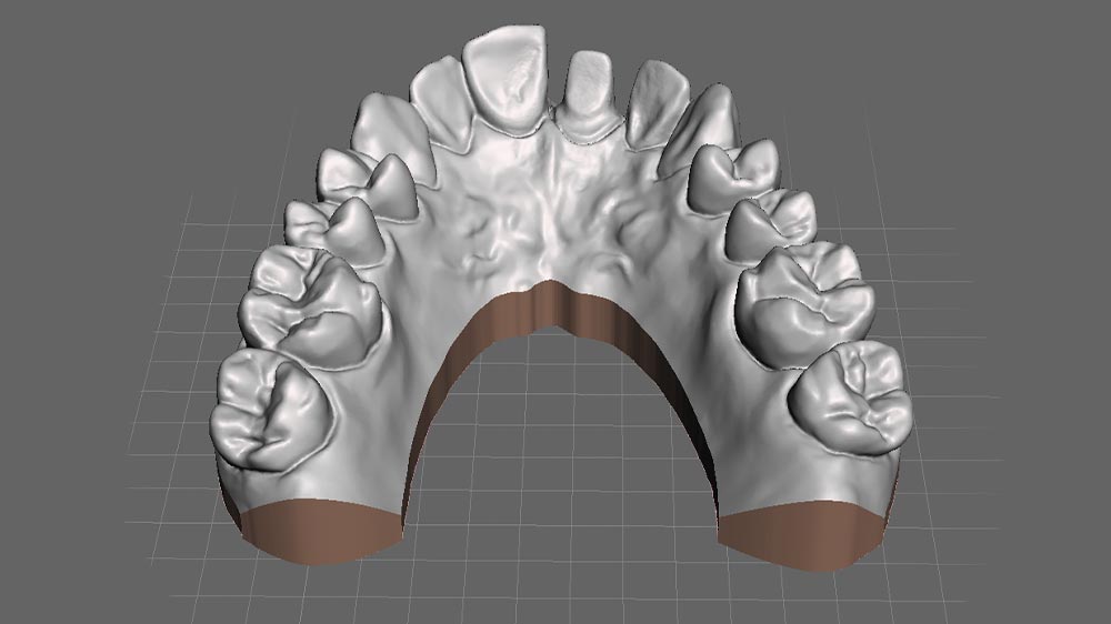 نمای نزدیک از قالب دندان از طریق اسکن سه بعدی دیجیتالی