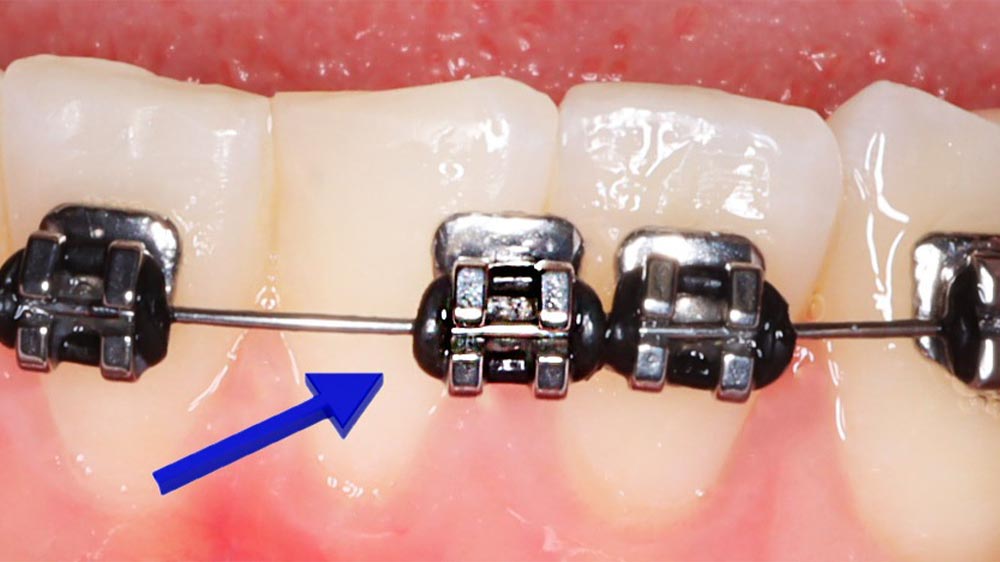 جدا شدن براکت ارتودنسی از روی دندان که با فلش آبی رنگ نشان داده شده است.
