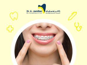 woman showing her tooth under orthodontic treatment