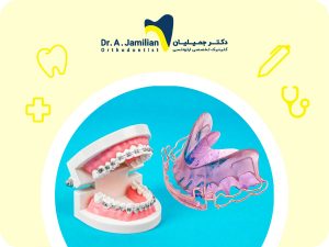 مقایسه ارتودنسی ثابت و متحرک