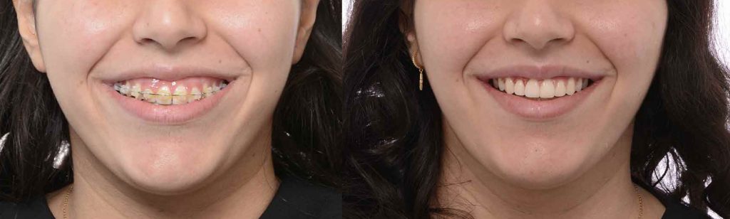 تاثیر ارتودنسی بر ظاهر لبخند لثه ای