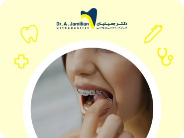 کش ارتودنسی چیست و نقش آن در درمان ارتودنسی چگونه است