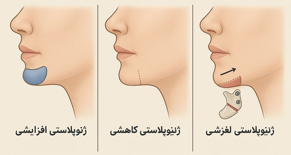 سه روش اصلی جراحی چانه یا ژنیوپلاستی
