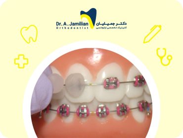 موم ارتودنسی چیست