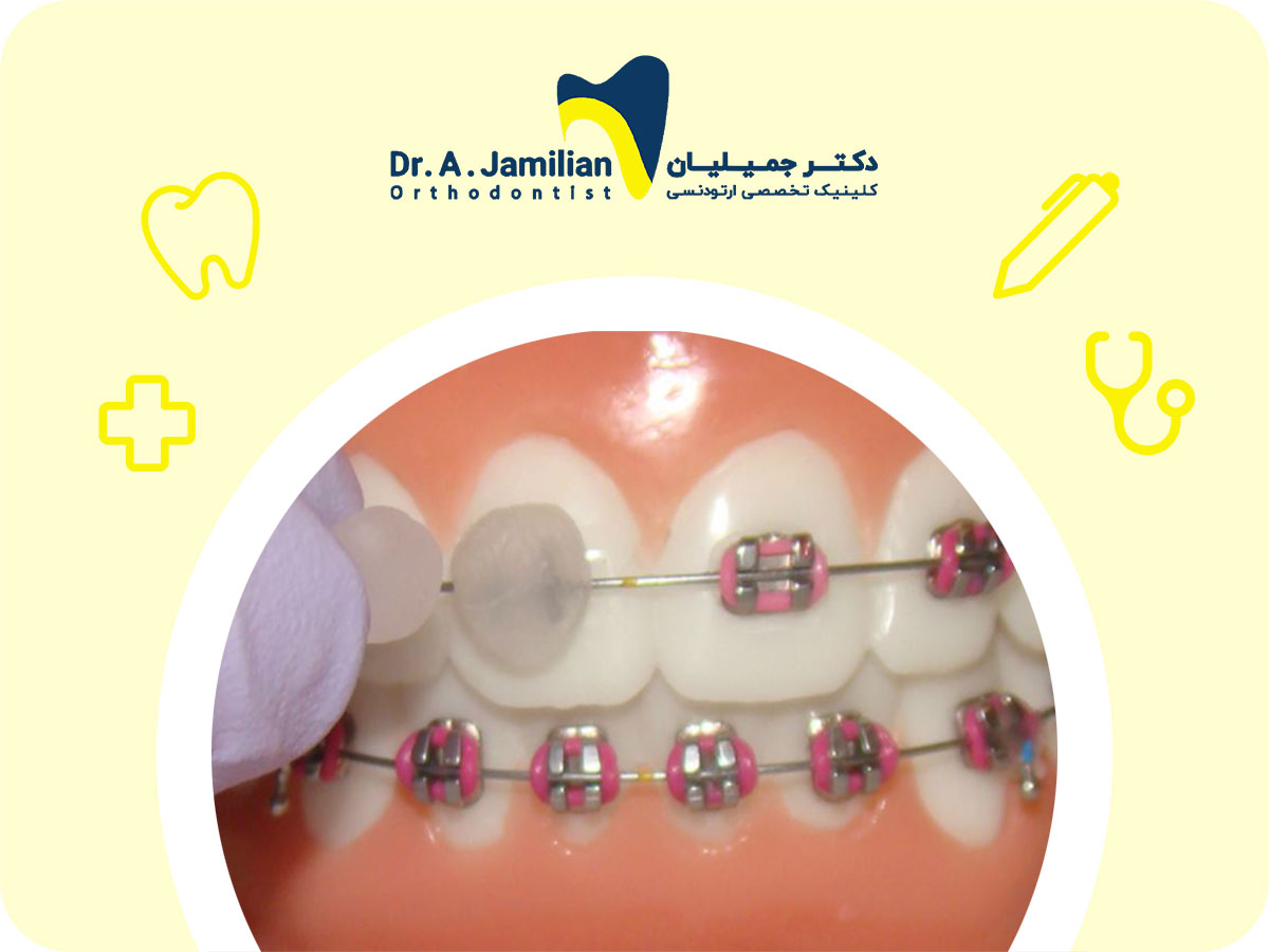 موم ارتودنسی چیست
