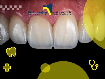 نازک شدن دندان های جلو علت درمان پیشگیری