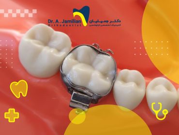 orthodontic band used on a tooth