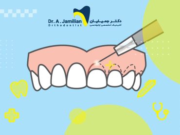 جراحی لثه راهکار درمانی نمایان کردن دندان ها
