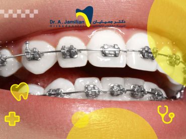 تمیز کردن و نگهداری از ارتودنسی ثابت برای داشتن دندان های سفید و سالم