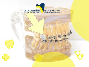 موم ارتودنسی که بر روی براکت ارتودنسی ثابت است و ممکن است بلعیده شود.
