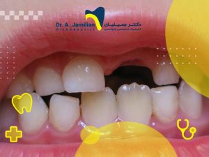 طفل يفتقد أسنانه اللبنية الأمامية