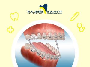 فنر ارتودنسی مورد استفاده در دو طرف فک