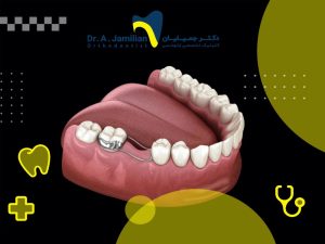 مثبت المسافة المستخدم في الفك السفلي