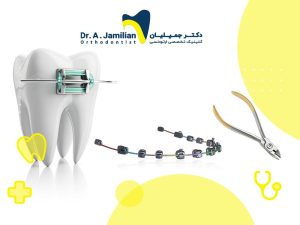 انبر ارتودنسی، بریس و دستگاه ارتودنسی روی یک دندان
