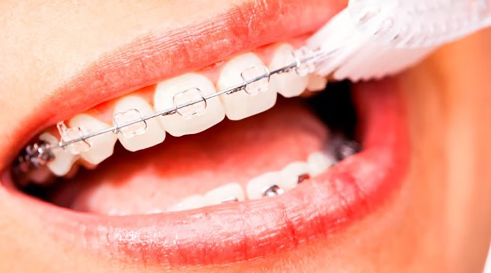 نمای نزدیک مسواک زدن ارتودنسی سرامیکی