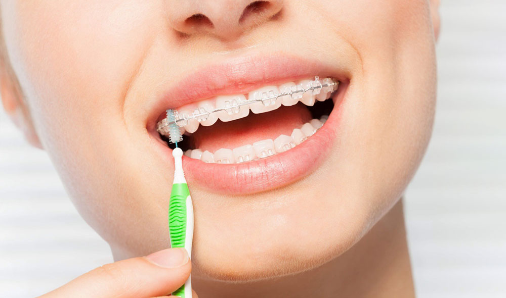 بیماری که با مسواک مخصوص ارتودنسی سیم و براکت ارتودنسی سرامیکی را تمیز می کند