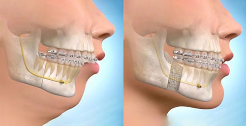 قبل و بعد جراحی فک پایین همراه با ارتودنسی دندان