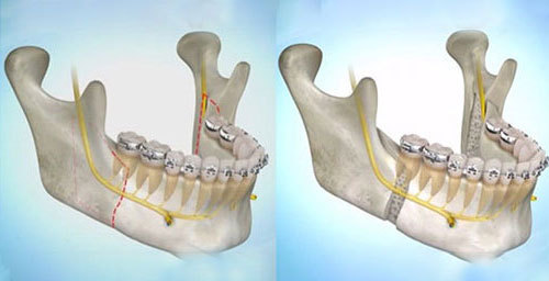استخوان فک پایین عقب مانده که با درمان همزمان جراحی فک و ارتودنسی دندان اصلاح شده است.