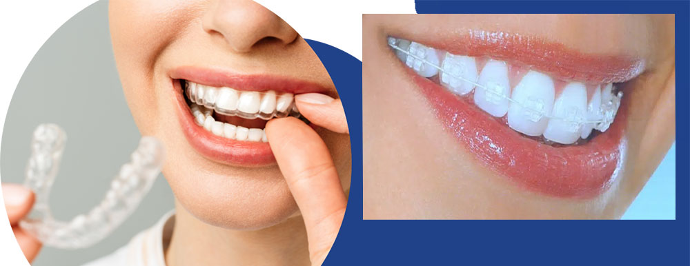 سمت چپ اینویزیلاین یا الاینر شفاف ارتودنسی سمت راست ارتودنسی سرامیکی