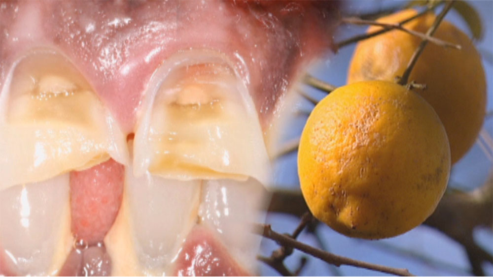 اسید لیموترش که به دندان پوسیده آسیب جدی رسانده است.