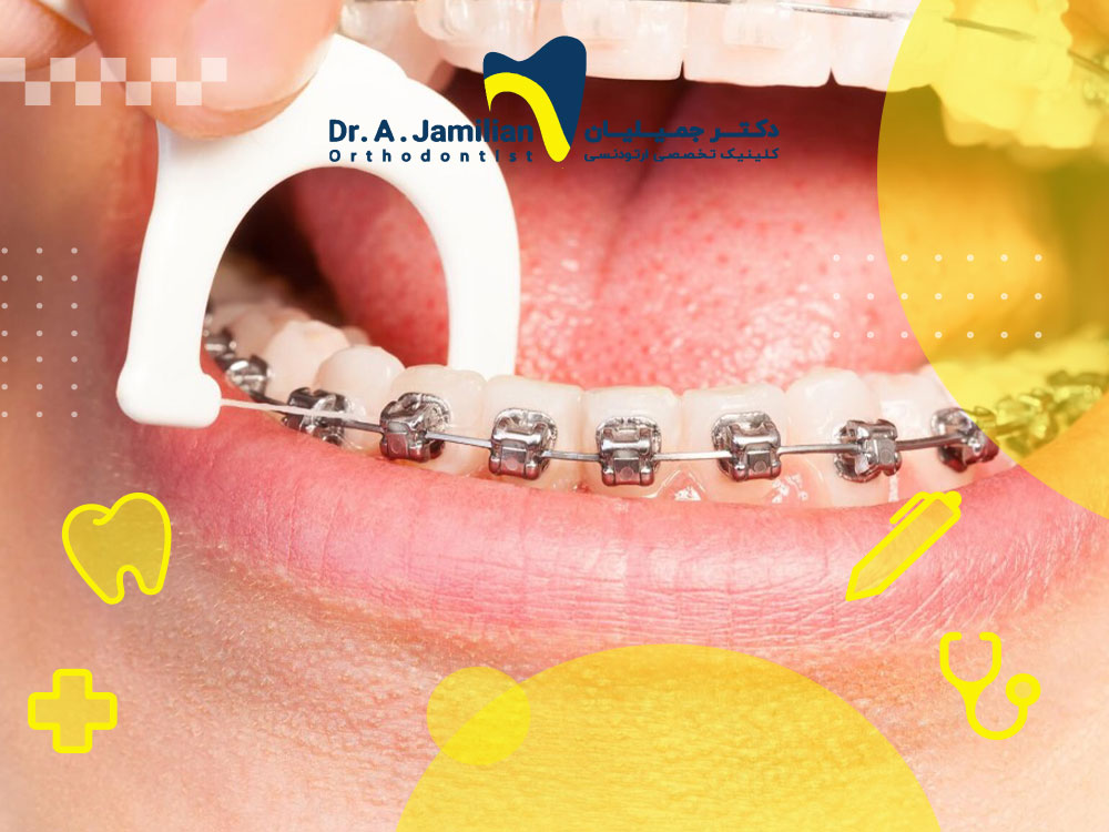 چرا نخ دندان ارتودنسی ضروری است؟